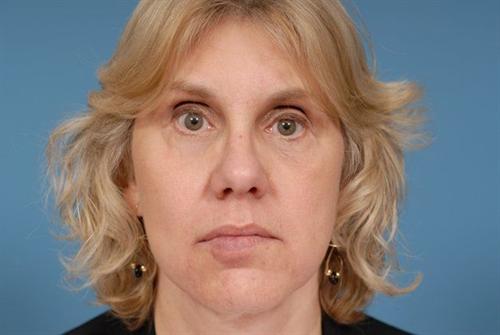 Facelift Before After Photos Patient 36 Edina Mn Facial Plastic Surgery Edward Szachowicz Md